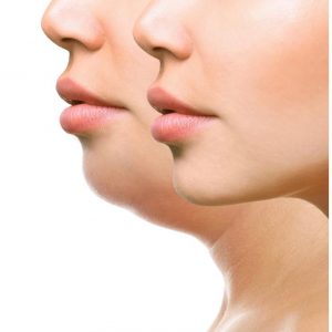 Fat dissolving LG House of Beauty