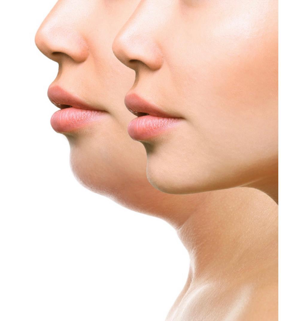 Courses4 Fat dissolving LG House of Beauty